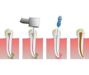Endodoncia