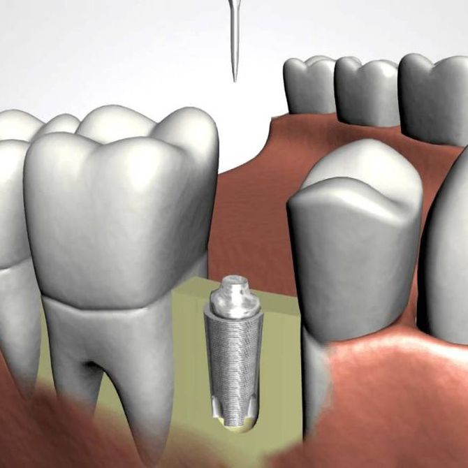 ¿Conoces las ventajas de los implantes dentales?