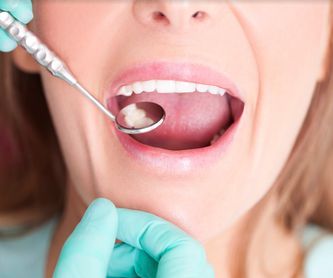 Implantes: SERVICIOS de Altes Dental