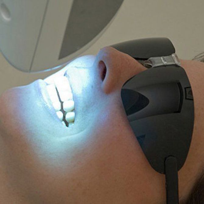 ¿Por qué se recomienda el blanqueamiento dental?