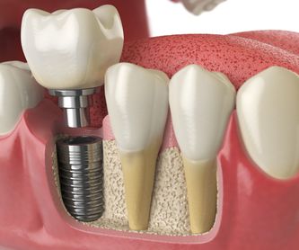 Prótesis: Diagnóstico y prevención de Clínica Dental Doctoras Álvarez y Frutos