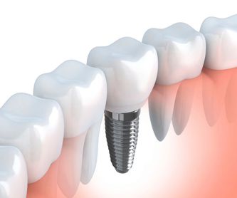 Endodoncia: Servicios de CEO Clínica Dental