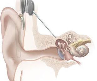 Reparación audífonos
