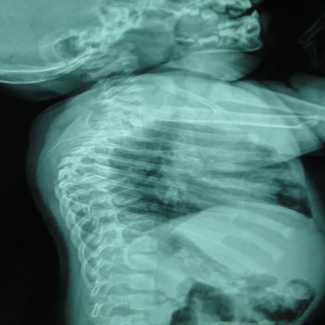 Lo que debes saber sobre la espina bífida