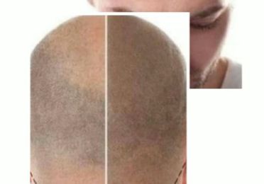 Micropigmentacion capilar