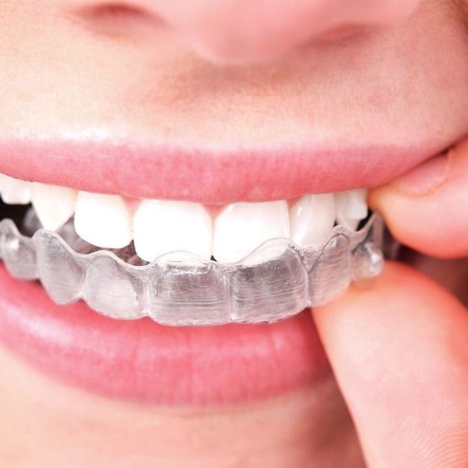 Cuidados para pacientes con ortodoncia invisible