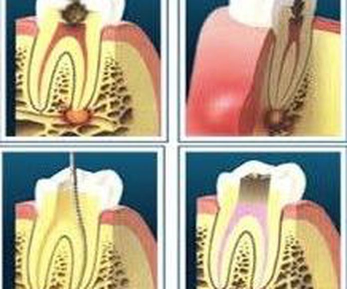 Endodoncia: Tratamientos de VERÓNICA URZÚA JATIB