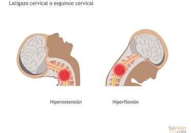 Latigazo cervical / Cervicalgias