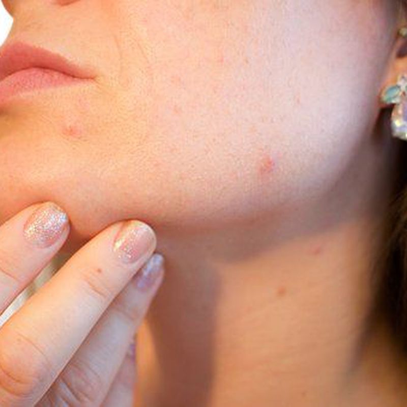 Acné: Dermatología y Dermoestética de Dermatología Socorro Fierro