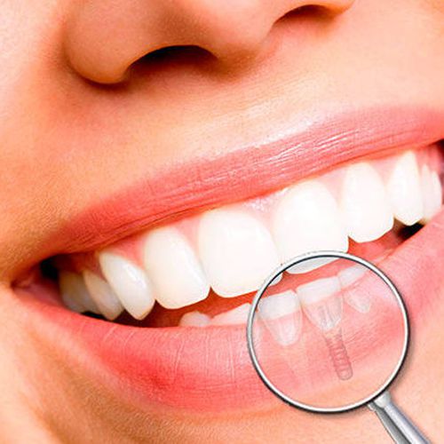 Implantes dentales en Gálvez