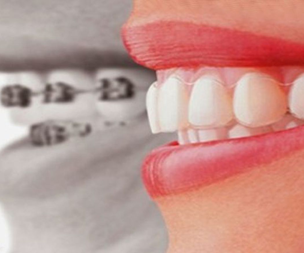 ¿Conoces la ortodoncia invisible? 