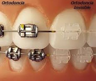 Ortodoncia fija