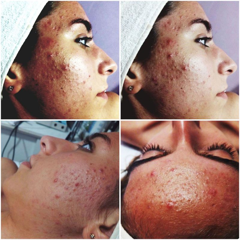 Antes del tratamiento del acné