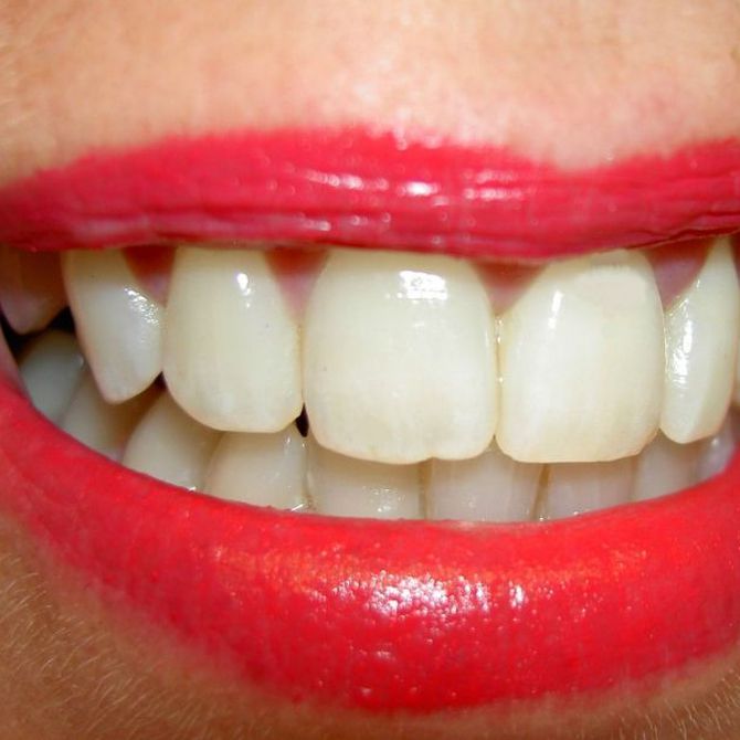 ¿Sabes por qué salen manchas blancas en los dientes?