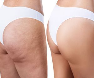 ¿Qué hacer para reducir la celulitis?