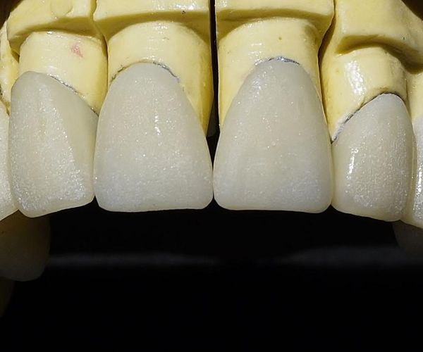 Protésicos dentales en Segovia | Calidad Tecnident 98, S.L.