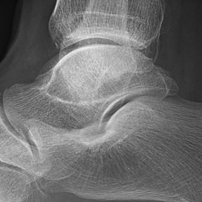 Qué es la tendinitis aquilea