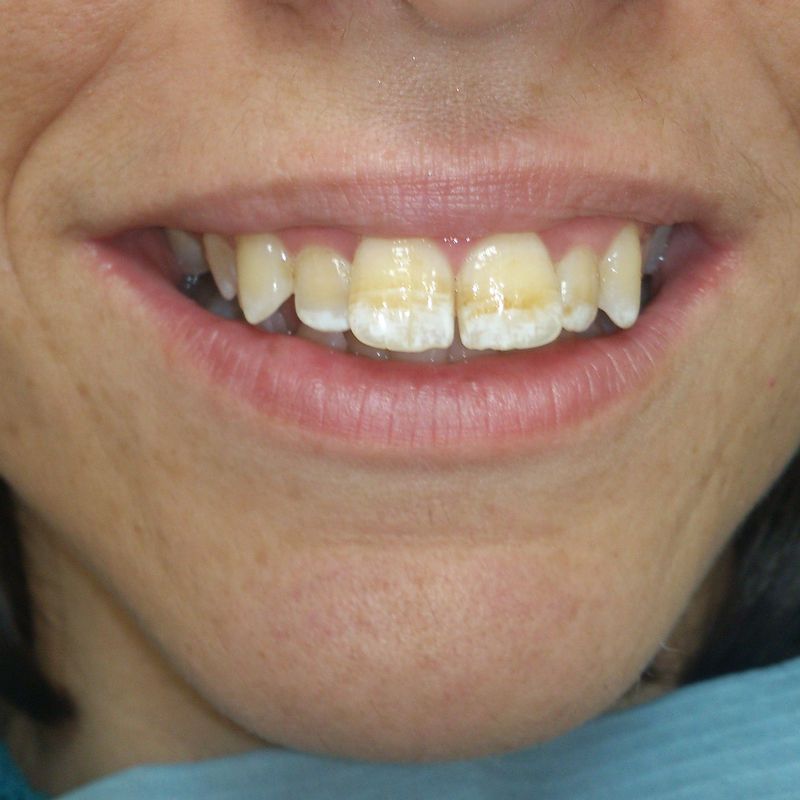 Carillas porcelana: Tratamientos de Clínica Dental Tucán