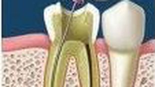 Imagen de Tratamientos - Endodoncia