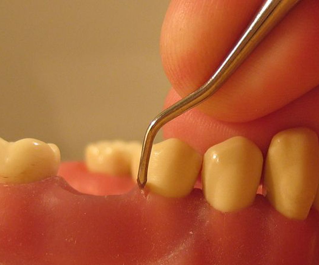 ¿Cómo tratar una periodontitis?