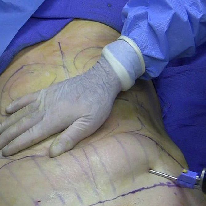 ¿Qué es una abdominoplastia?