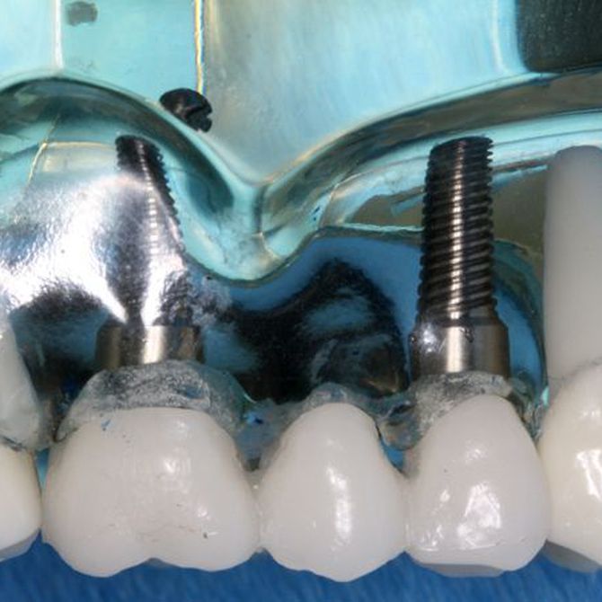 Ventajas del tratamiento de implantes dentales