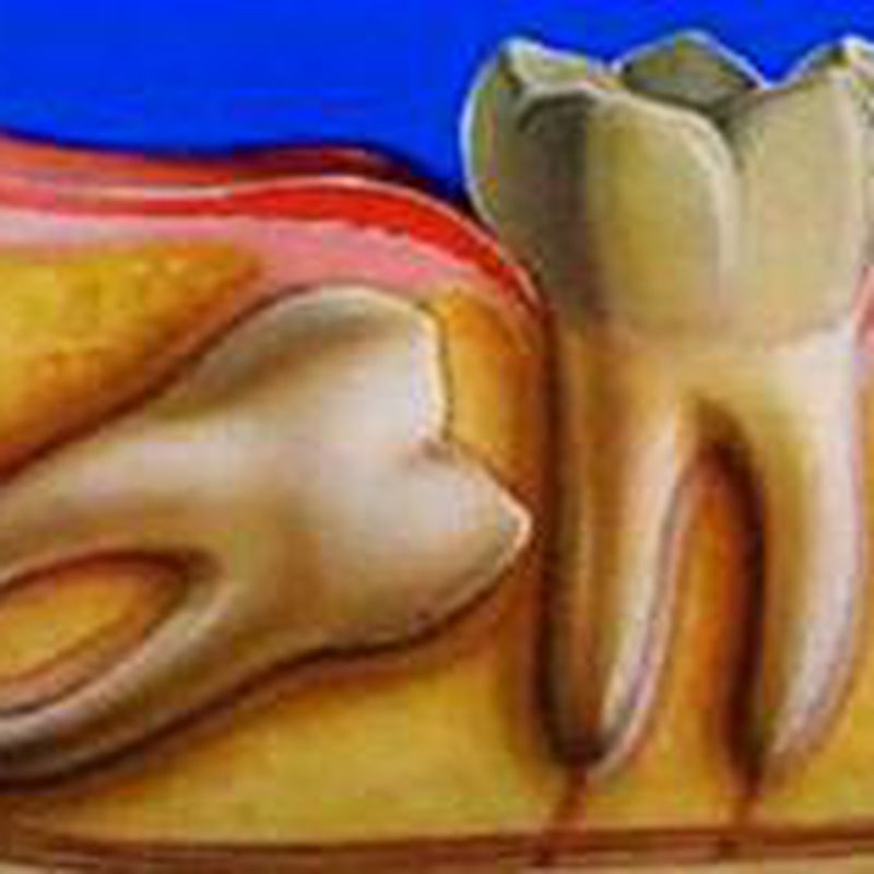 Cirugía oral: Tratamientos de Hospident Clínica Dental