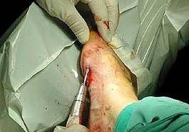 Cirugía del pie 