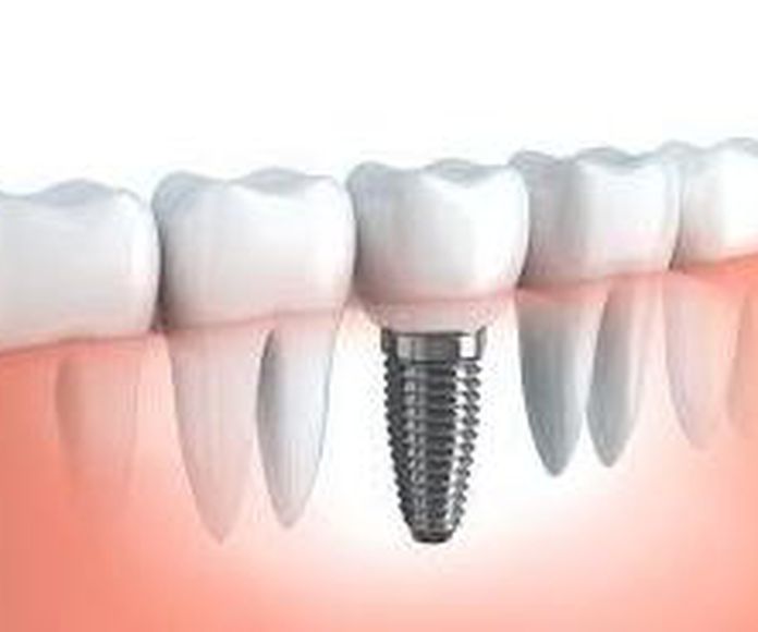 Implantes dentales: Tratamientos de Clínica Dental Fortaña-Giménez }}