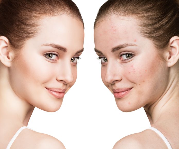 Tratamiento facial para el acné: Nuestros Servicios de Centro de Belleza Mª Ángeles