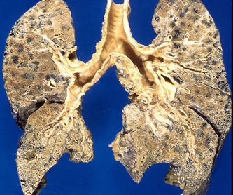 Cáncer de pulmón: Neumología de José  María  Ignacio Garcia