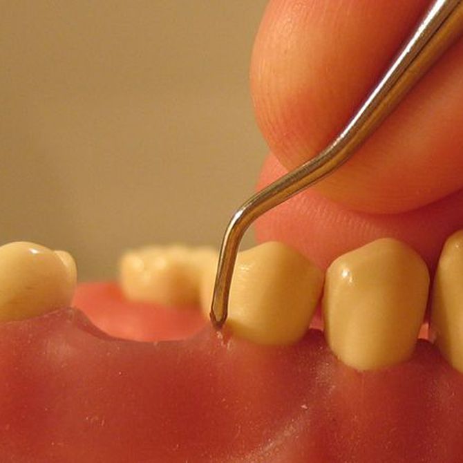 Cómo evitar enfermedades periodontales