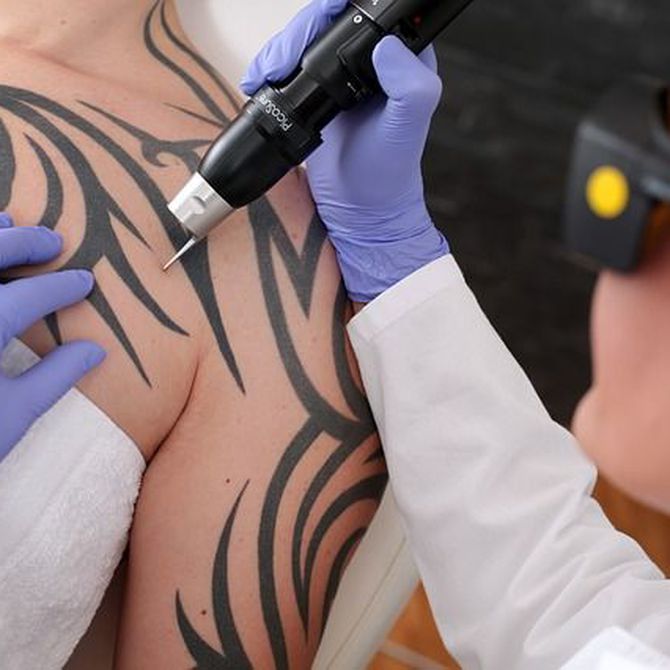 Aspectos a conocer sobre la eliminación de los tatuajes