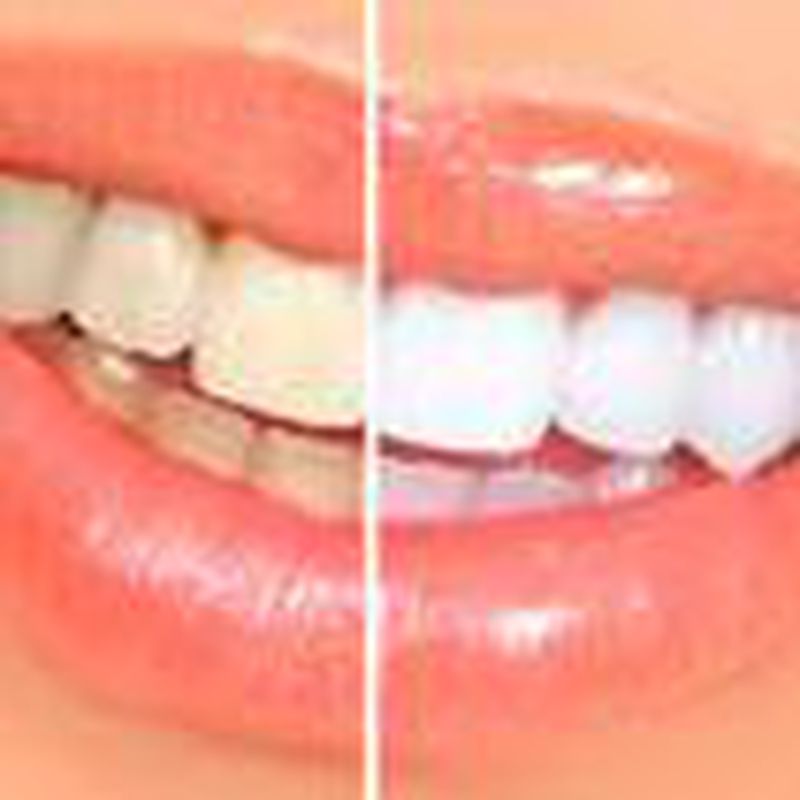 Estética dental 