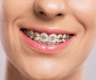 Ortodoncia para adultos : Ortodoncia de Isabel Perales Clínica Dental