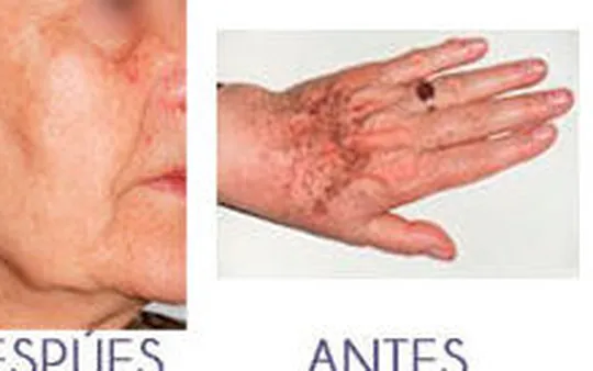 Fotorejuvenecimiento (facial, escote, manos)