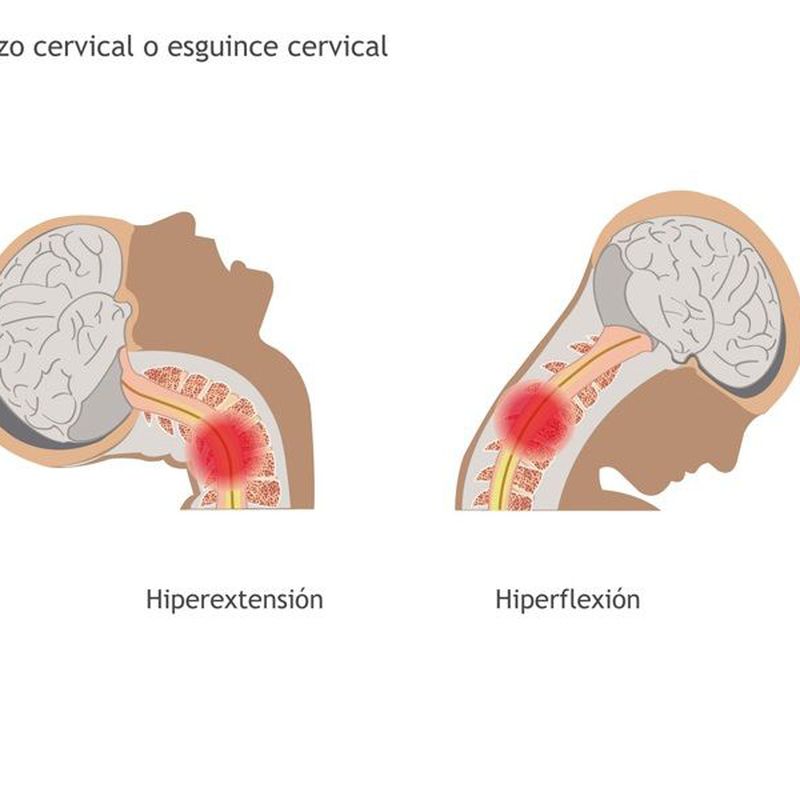 Latigazo cervical / Cervicalgias: Servicios de Fisiomas