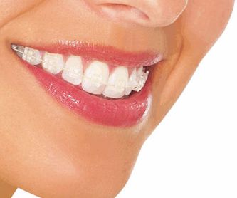 Ortodoncia Invisalign: Servicios de Clínica Dental Dra. Esther Blánquez