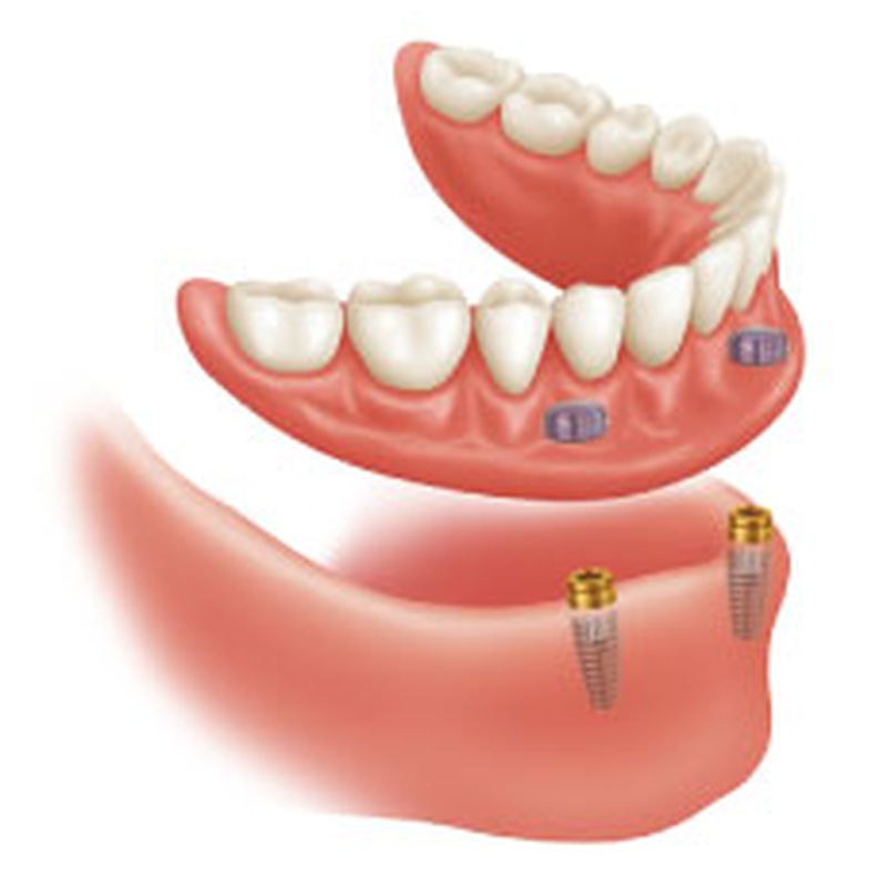 Prótesis dental: Tratamientos de Dental Valls