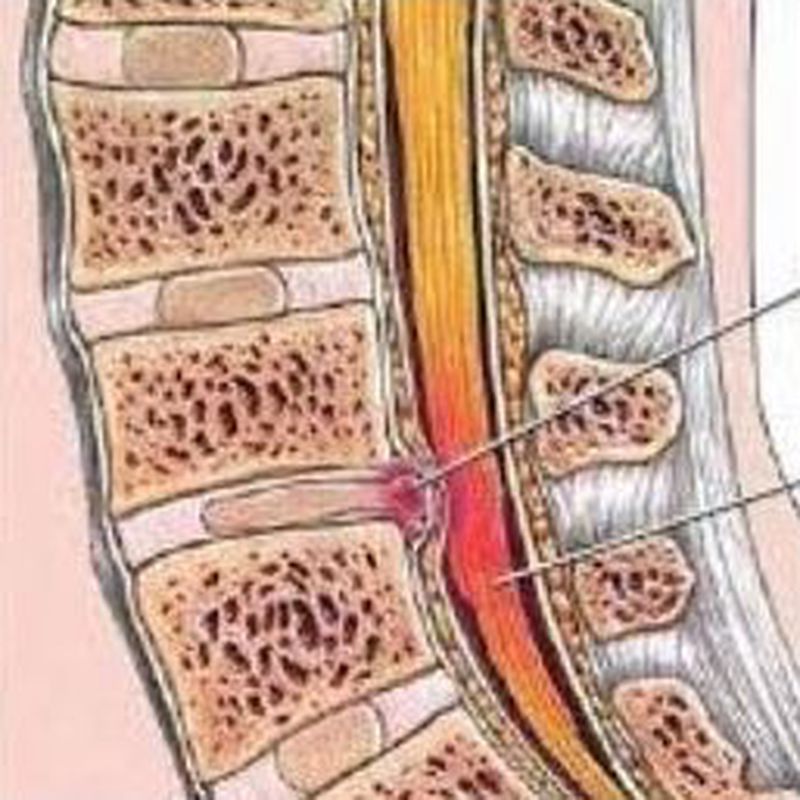 Hernia posterior en zona lumbar