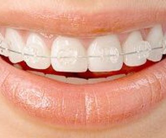 Invisalign niños: Servicios de Ortodoncia Pierre Kallai