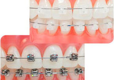 Ortodoncia dental fija (brackets)