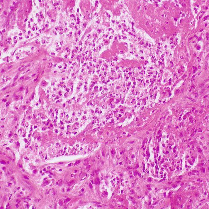 La candidiasis afecta también a los hombres