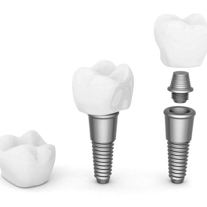 Implantes dentales, partes y materiales