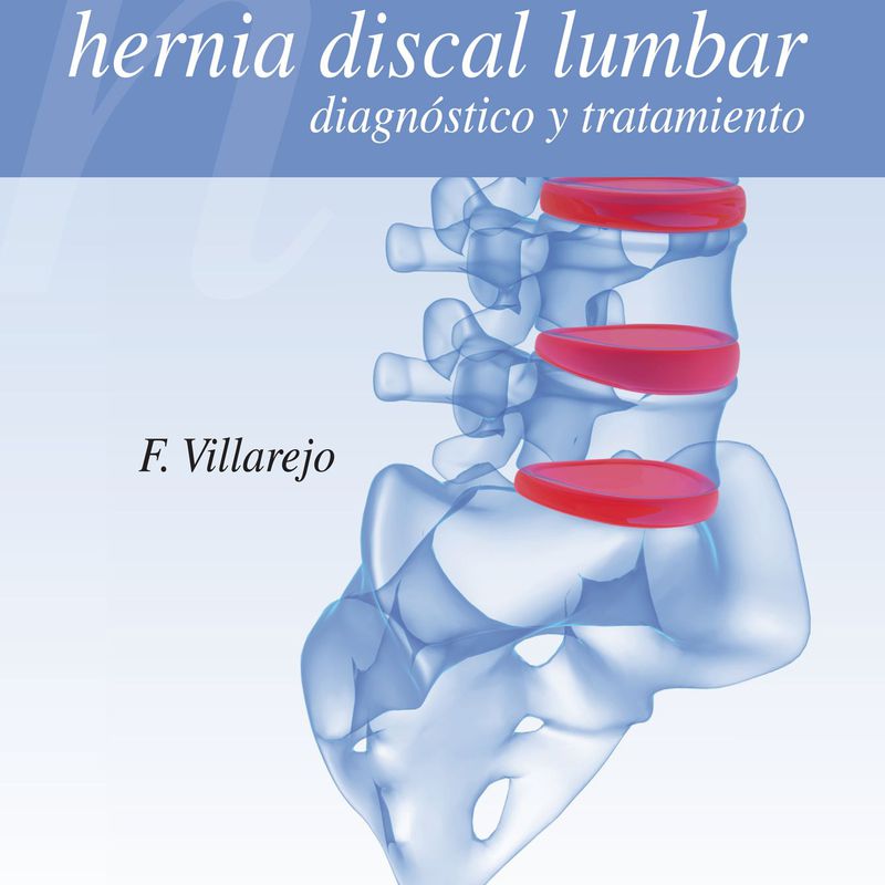 Hernia discal lumbar: diagnóstico y tratamiento: Especialidades y publicaciones de Doctor Villarejo