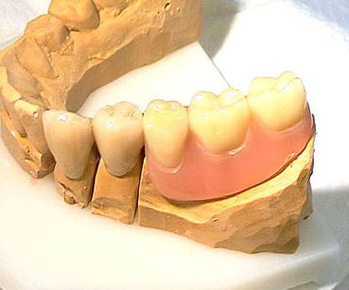 Prótesis fijas o puentes: Servicios de Clínica Dental El Carmen