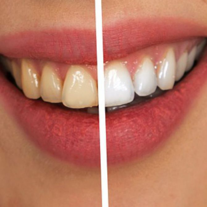 Los diferentes métodos de blanqueamiento dental