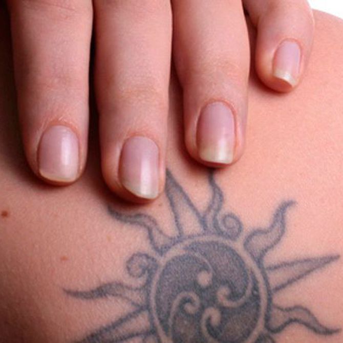 Eliminar un tatuaje sin dolor