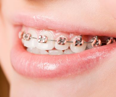 Consejos para disminuir las molestias de la ortodoncia