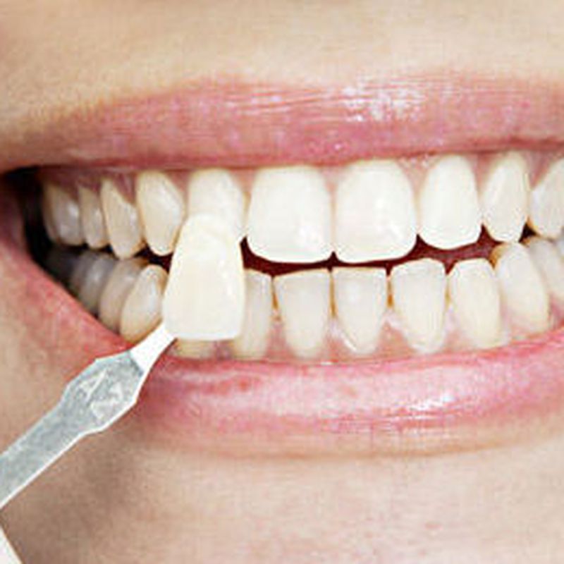 Estética dental: Tratamientos de Abando Hortz Klinika